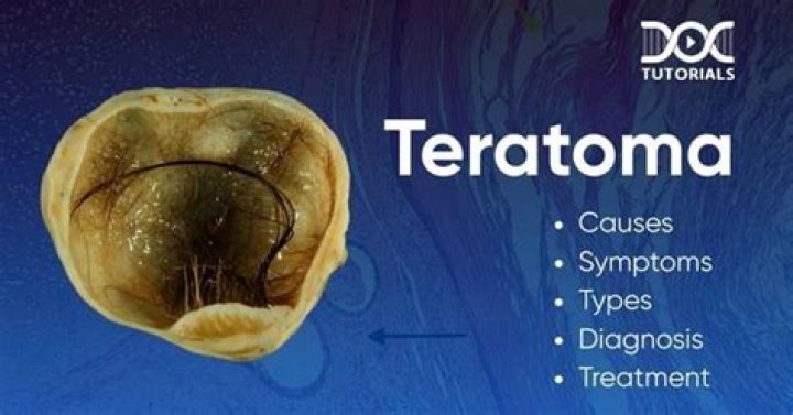 Is a teratoma a tumor?