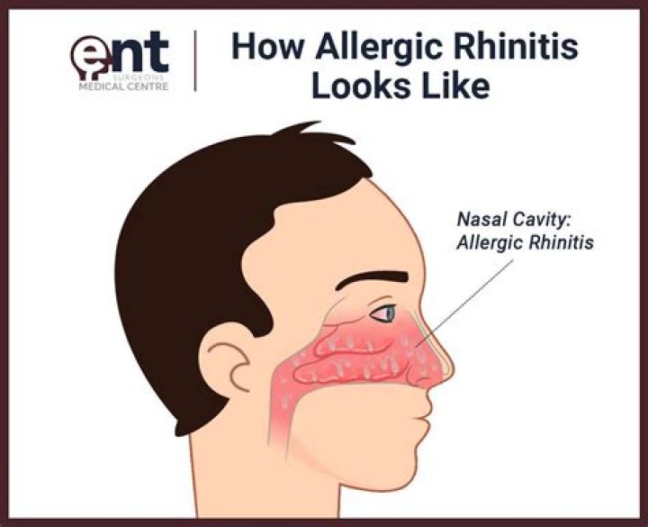Is allergic rhinitis can cause fever?