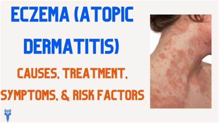 Is atopic dermatitis eczema?