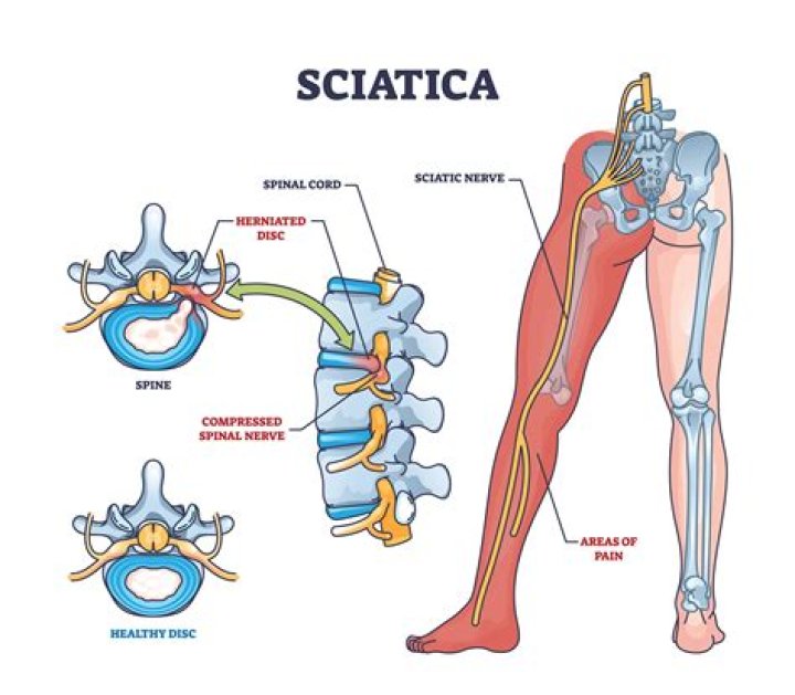 Is bilateral sciatica a red flag?