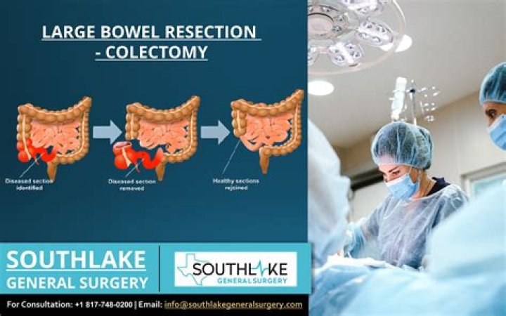 Is bowel resection major surgery?