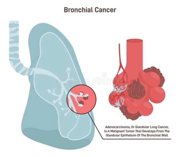 Is bronchial cancer curable?