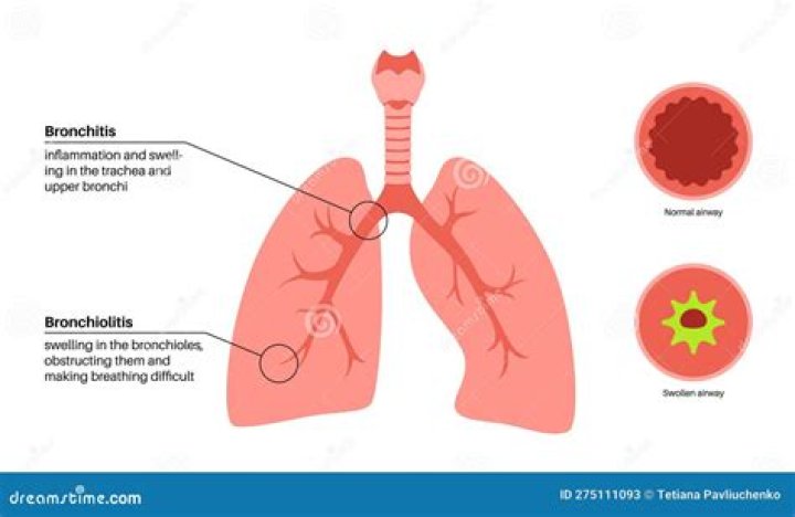 Is bronchitis contagious to others?