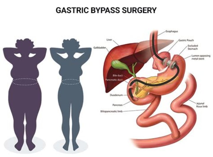 Is bypass surgery a operation?