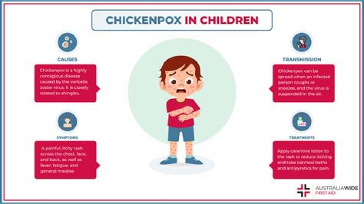 Is chicken pox catching?