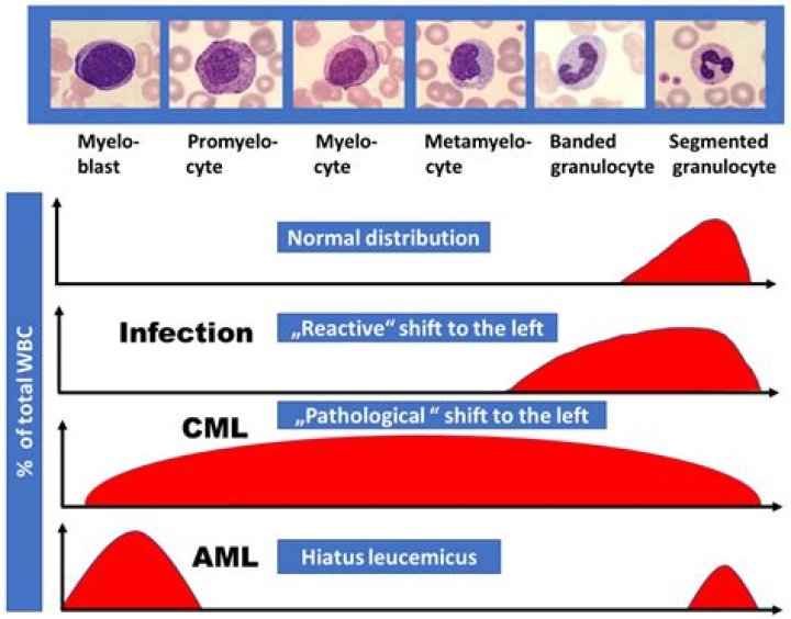 Is cml a disease?