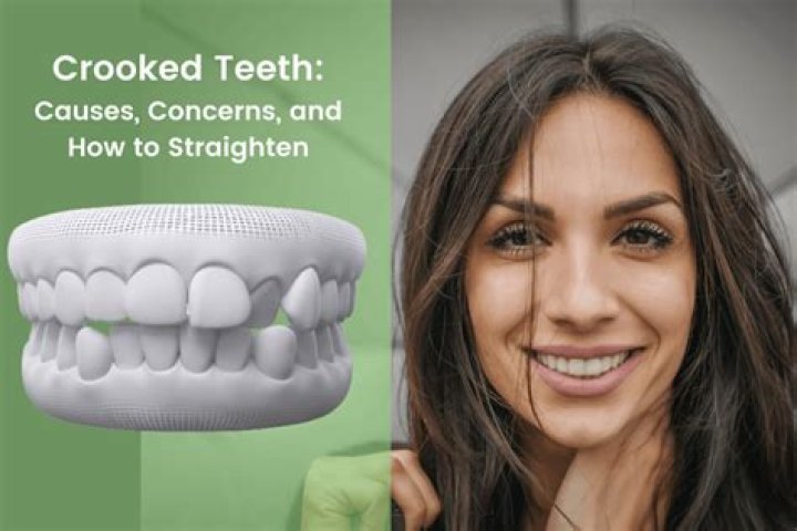 Is crooked teeth lucky?