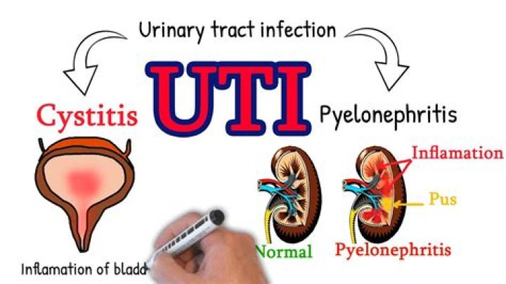 Is cystitis a uti?