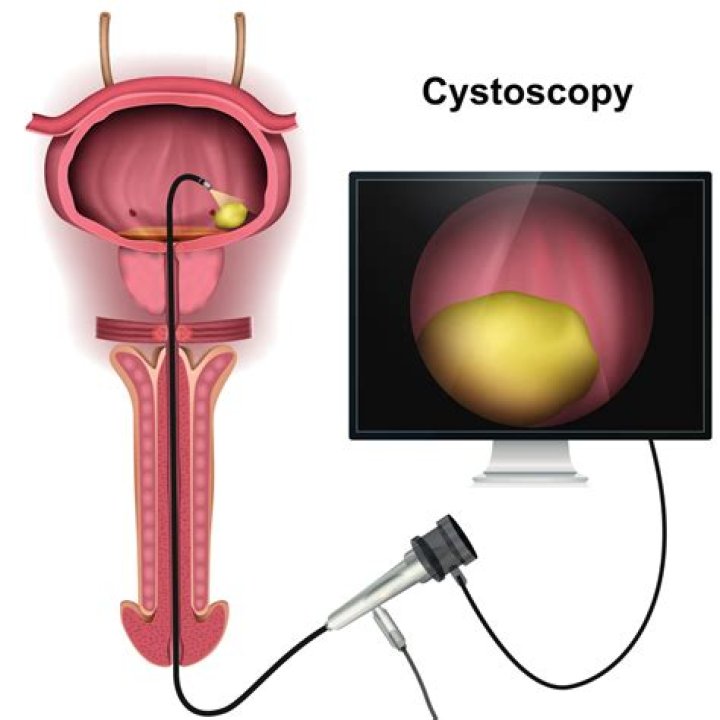 Is cystoscopy necessary after ct scan?