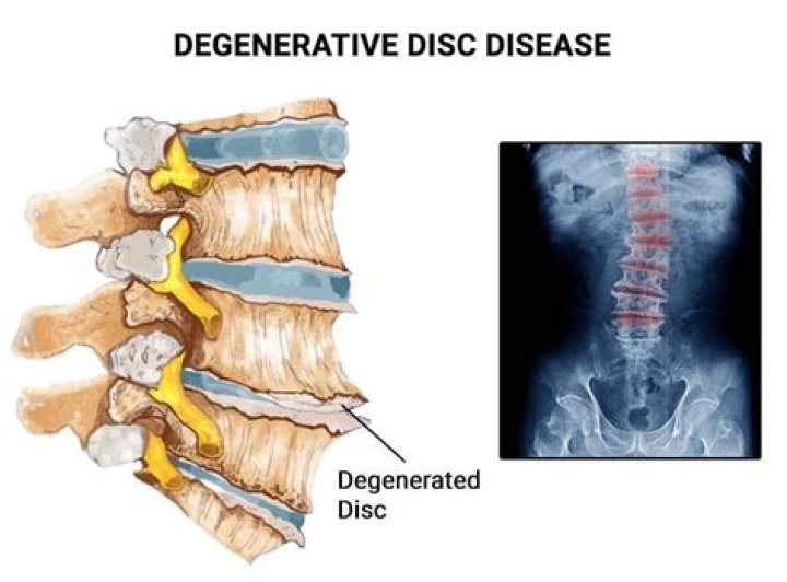 Is degenerative disc disease arthritis?