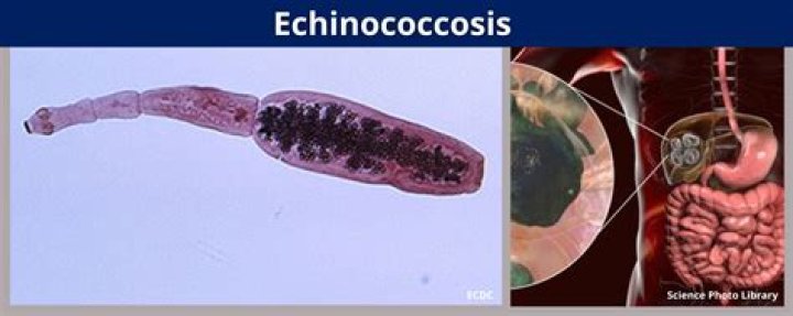 Is echinococcosis infectious disease?