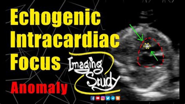 Is echogenic intracardiac focus normal?