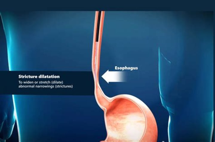 Is esophageal strictures curable?