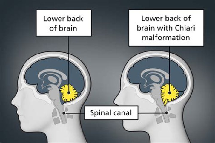 Is having a chiari malformation life threatening?