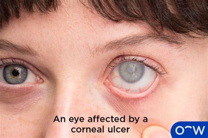Is it normal to wink with only one eye?