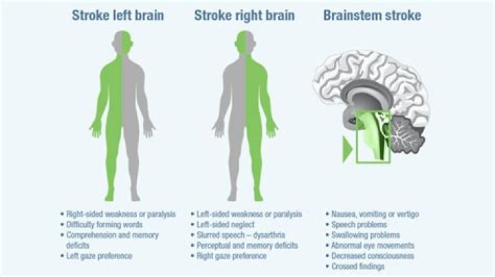 Is jerking a sign of stroke?