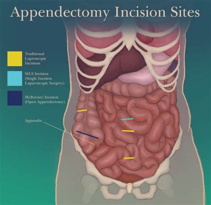 Is laparotomy a surgical incision?