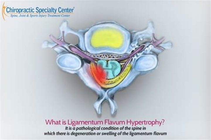 Is ligamentum flavum hypertrophy painful?