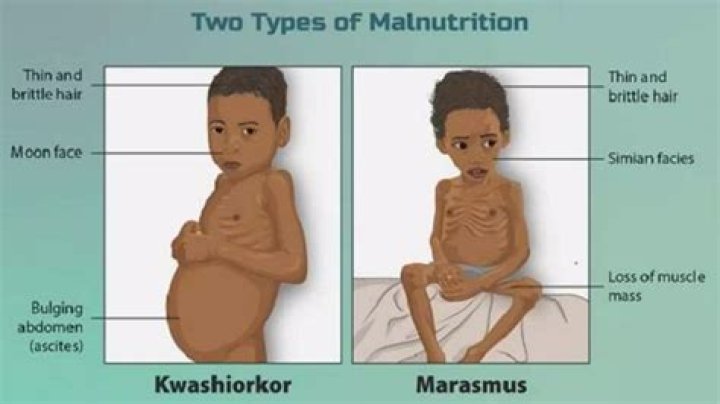 Is malnourished an adjective?