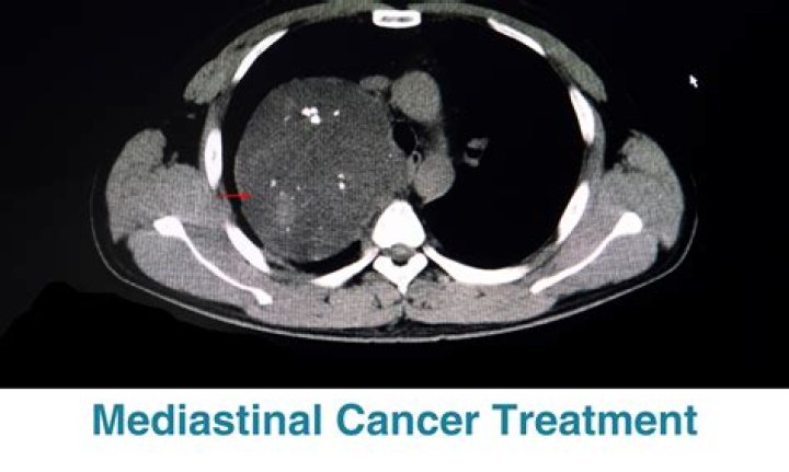 Is mediastinal teratoma cancer?
