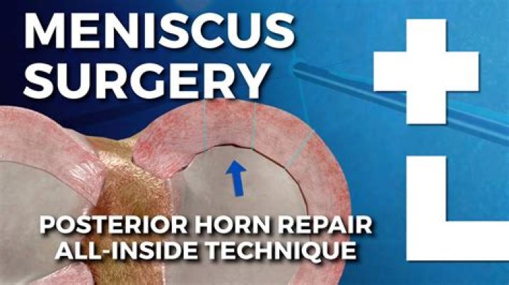 Is meniscus tear surgery outpatient?