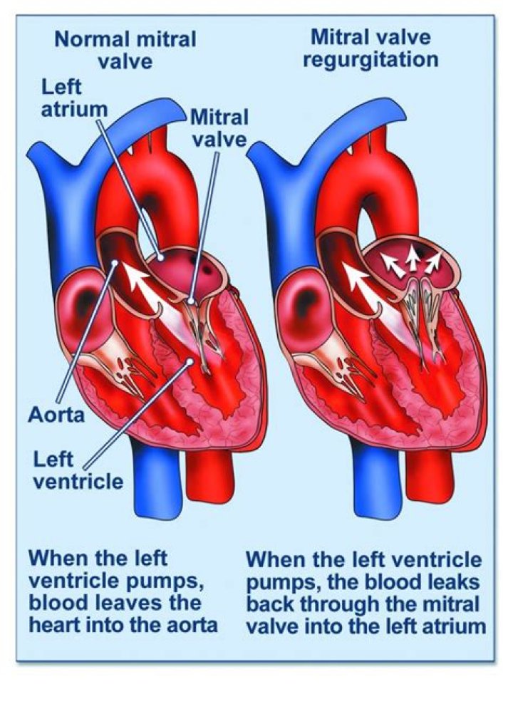 Is mitral valve regurgitation considered heart disease?