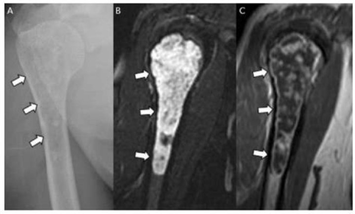 Is osteochondroma a malignant bone tumor?