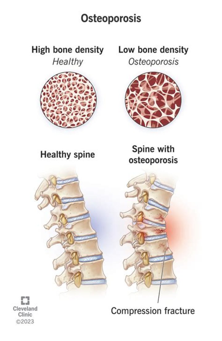 Is osteosis a word?