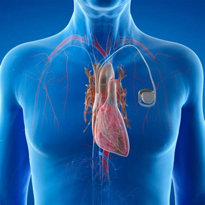 Is pacemaker a word?