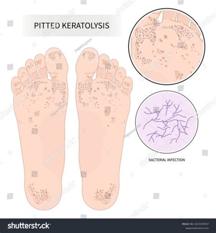 Is pitted keratolysis bad?