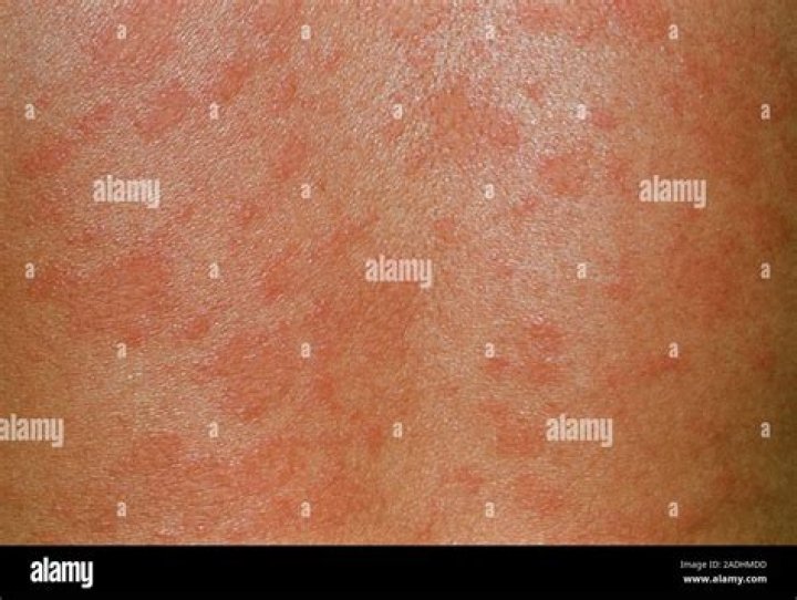 Is pityriasis lichenoides an autoimmune disease?