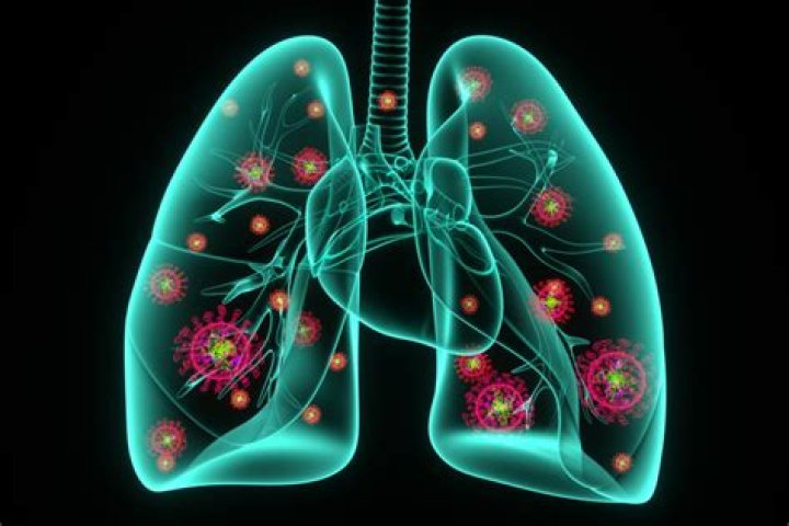 Is pneumonia a virus?