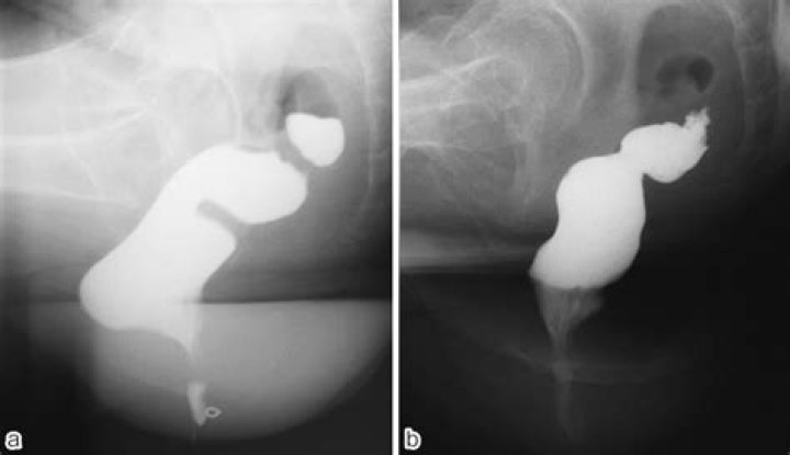 Is posterior colporrhaphy performed?