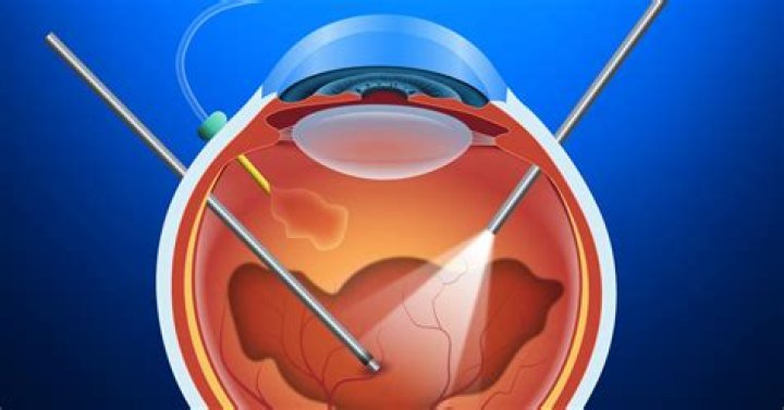 Is retina transplant possible?