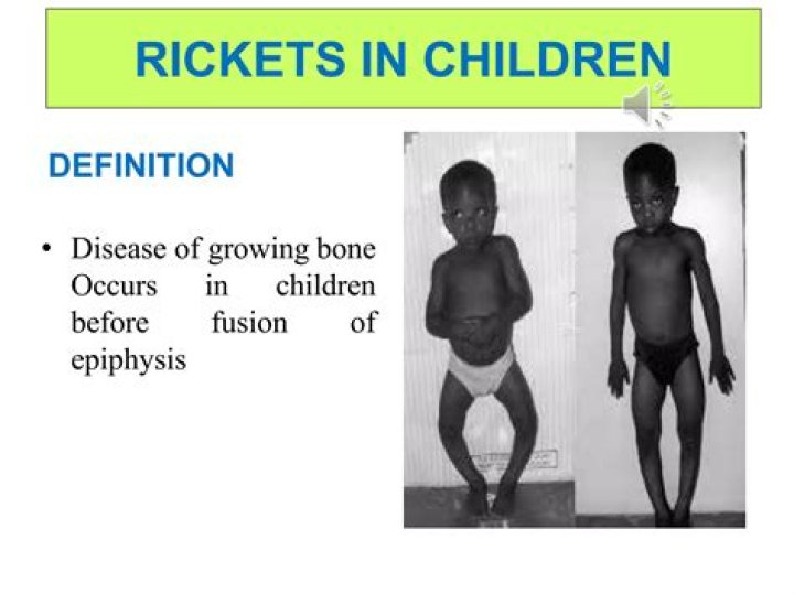 Is rickets a primary deficiency?