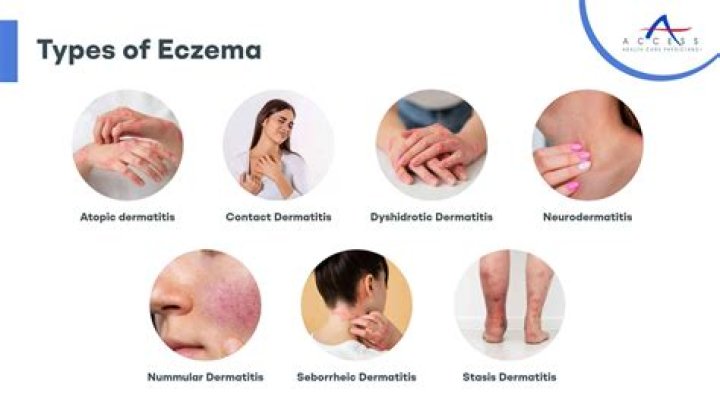 Is scrotal eczema curable?