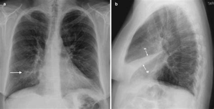 Is subsegmental atelectasis serious?
