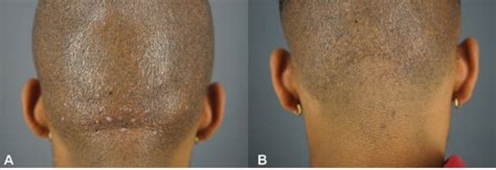 Is there a cure for acne keloidalis nuchae?