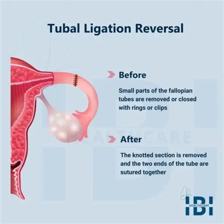 Is tubal reversal successful?