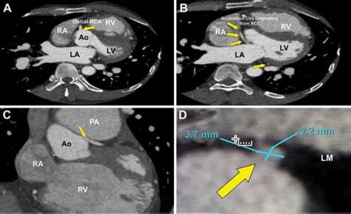 Is unroofed coronary sinus normal?