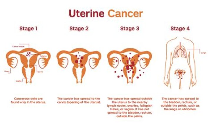 Is uterine cancer the same as endometrial cancer?