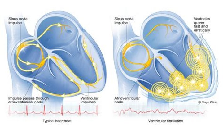 Is ventricular fibrillation pulseless?