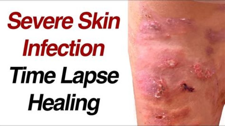 Should a skin infection be covered?