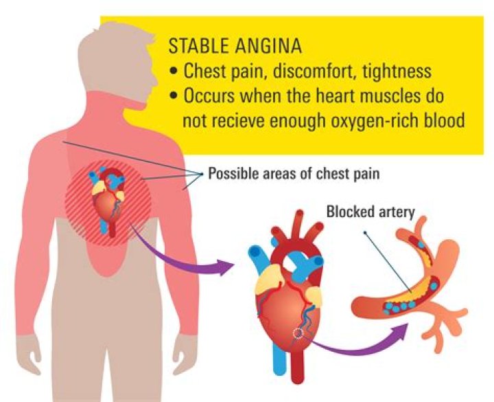 Should angina be treated?
