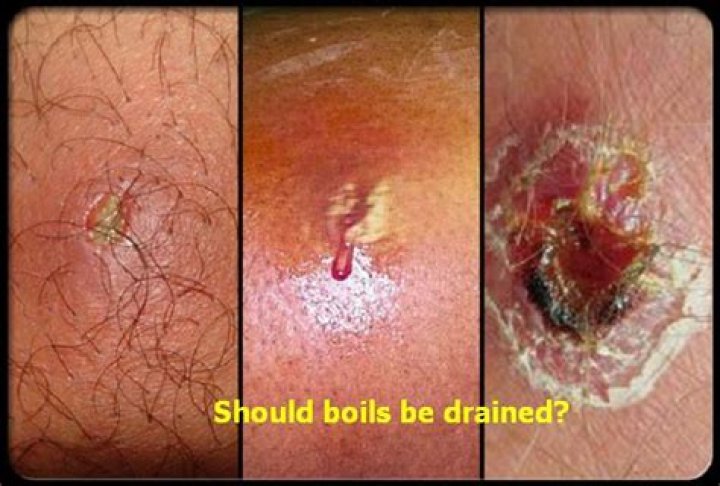 Should boils be drained?