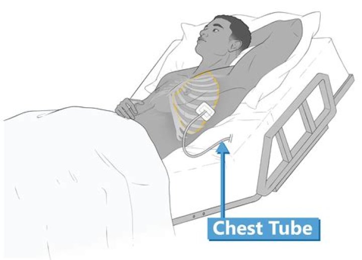 Should chest tube be clamped during transport?
