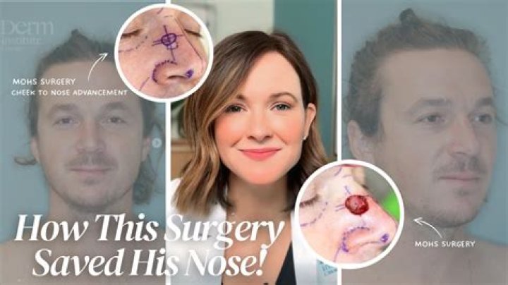 Should i have mohs surgery?