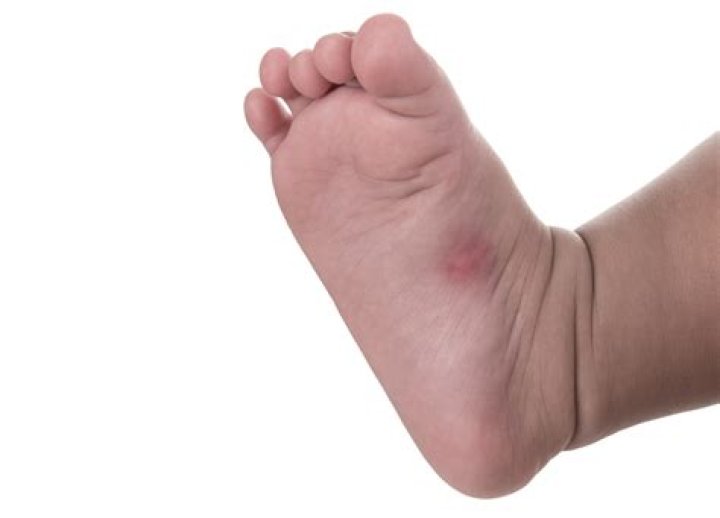 Should i pop ant bites on a toddler?
