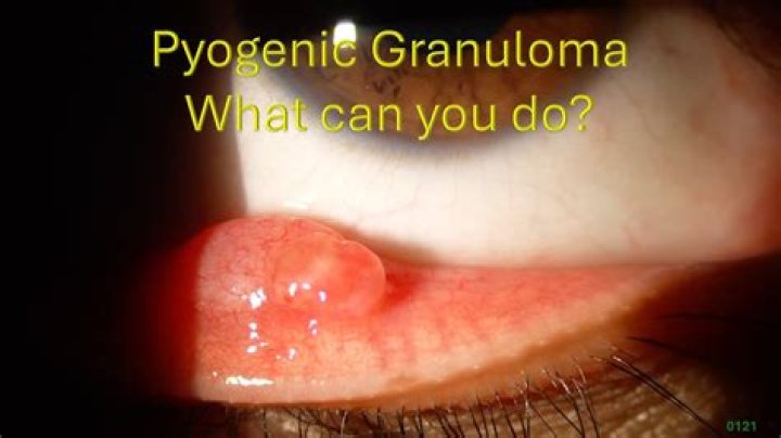 Should i pop my granuloma?