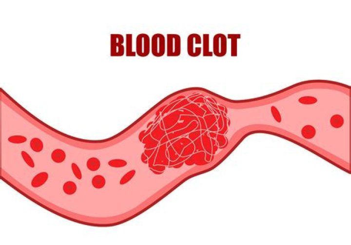 Should i put heat on a blood clot?